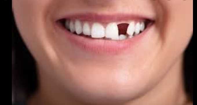 Reasons Why You Should Replace Your Missing Teeth